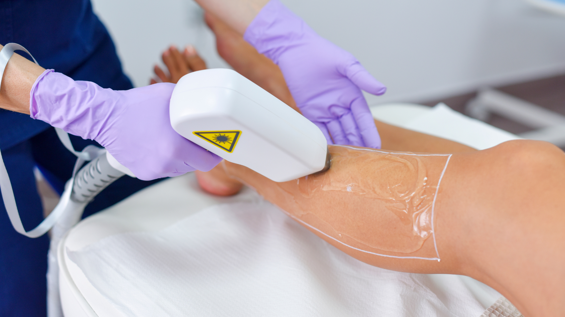 Operatrice di Ageless Estetica esegue epilazione laser sulle gambe di una cliente nel centro di Noale